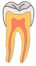 120px-pit-and-fissure-caries-gif.gif