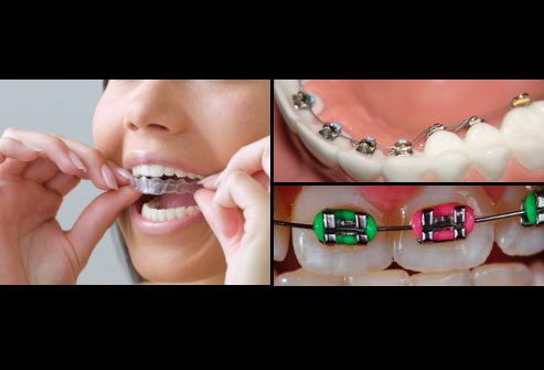collage_of_3_different_types_of_braces.jpg