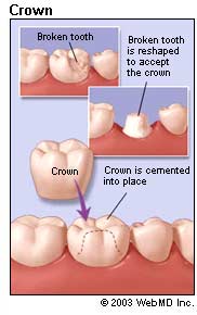 dental-health_crowns.jpg