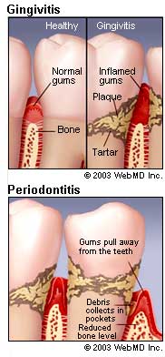 dental_health_gingivitis_periodontal_disease.jpg