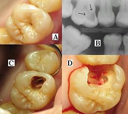 dentalcaries.jpg